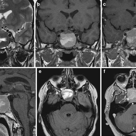 CT appearance of pituitary apoplexy. Arrows on axial (a), coronal (b ...