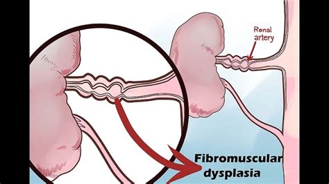 Renal Artery Stenosis - YouTube