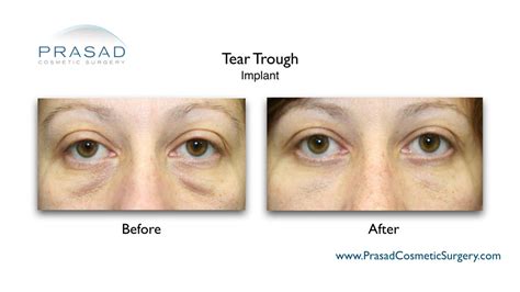 Tear Trough Implants for Hollow Under Eyes | New York