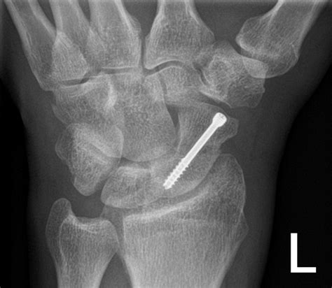 Scaphoid Fractures |Hand Injuries | The Hand Specialist