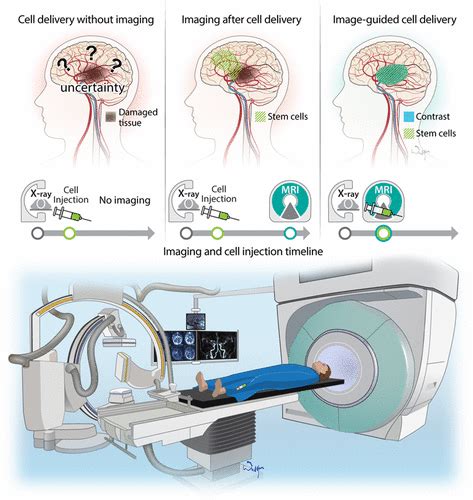 Intra-Arterial Delivery of Cell Therapies for Stroke | Stroke