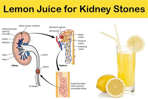 Cómo utilizar el jugo de limón para los Cálculos Renales Tratamiento ...