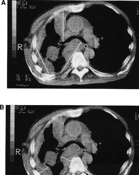 Malignant Pleural Mesothelioma | Semantic Scholar