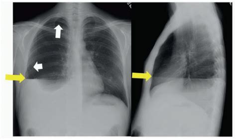 Hydropneumothorax | Radiology Key