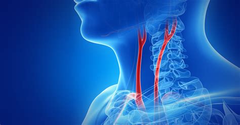 Carotid Body Tumor | Symptoms & Treatment | MedStar Health