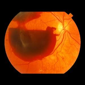 Vitreous Hemorrhage Treatment | Retina Macula Specialists of Miami