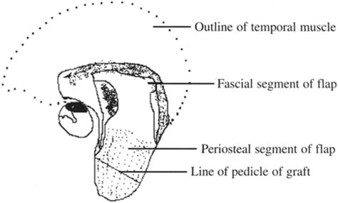 Diagram shows completely elevated flap with both periosteal and fascial ...