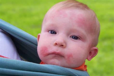 How To Effectively Apply Ringworm Treatment For Toddlers