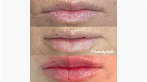 Hyaluronic Acid Lip Injections At Home at mollysbradley blog