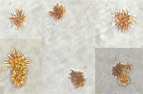 Bilirubin crystals found in a patient's urine with a history of ...