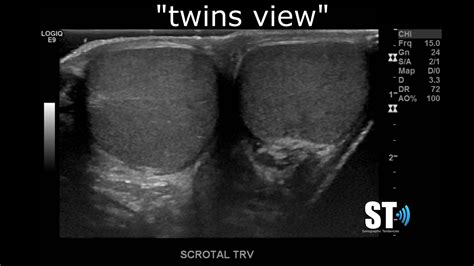 Testicular/Scrotal Doppler Protocol – Sonographic Tendencies