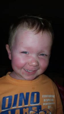 Allergic Reaction to Sunscreen? | BabyCenter