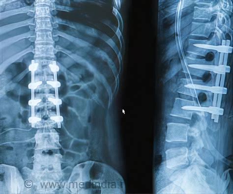 Spinal Fusion - Types, Risks, Complications & Prognosis