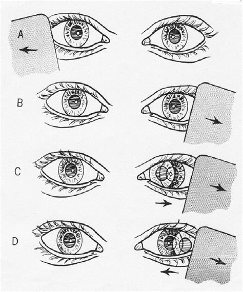 5 . The Unilateral Cover Test. (A) The cover has been removed from the ...