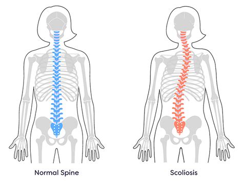 SCOLIOSIS DOCTORS - Professional Community Article By Premier Brain & Spine