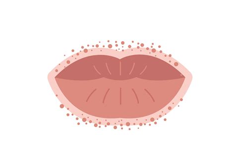What Allergy Causes Swollen Lips - Infoupdate.org