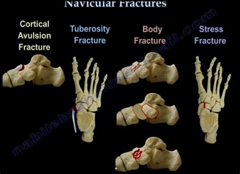 Navicular Fractures — OrthopaedicPrinciples.com