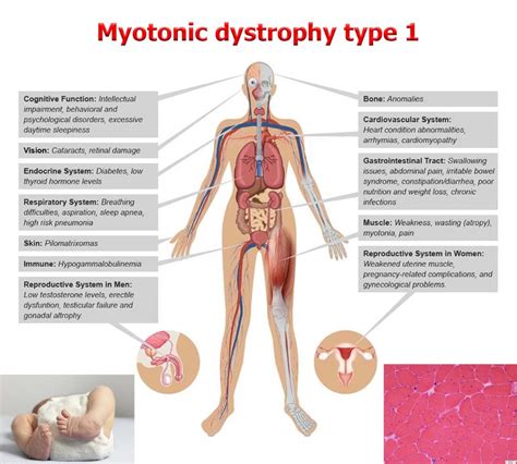 Discovered new therapy to treat myotonic dystrophy type 1 - https://debuglies.com