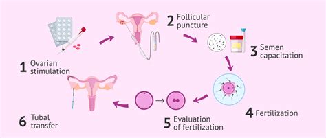 ZIFT procedure