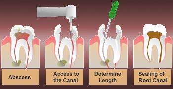 Single Sitting Painless RCT at Dr Agravat Dental clinic ahmedabadFamous ...