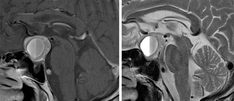 Pituitary apoplexy 2 – Radiology Cases