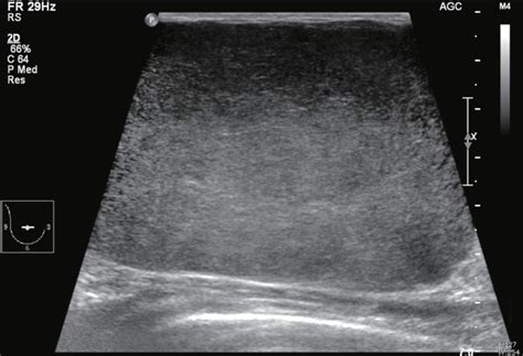 An ultrasonogram showing a well capsulated giant homogeneous isoechoic ...