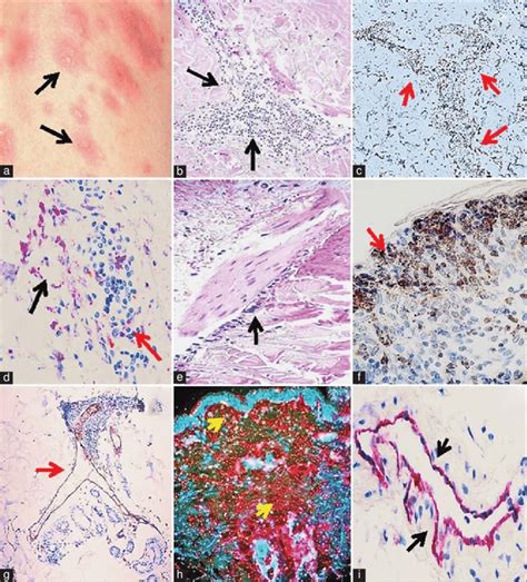 (a) Shows multiple erythematous plaques and vesicles in the legs of the... | Download Scientific ...