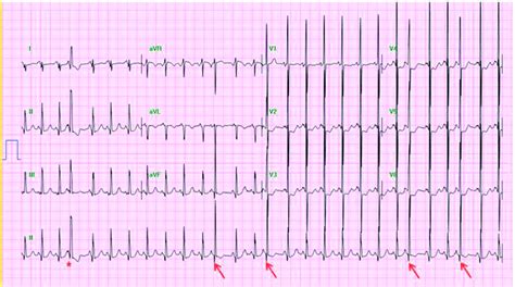 Premature atrial complexes. A premature and unrecognized P wave occurs... | Download Scientific ...