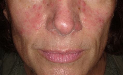 The Gut-Face Connection in Rosacea: Exploring the Role of H pylori - Dermatology Advisor