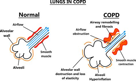 Chronic obstructive pulmonary disease (COPD)