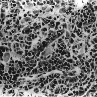 (PDF) Impression cytology of conjunctival melanosis and melanoma