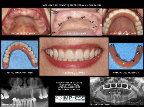 Teeth-In-One-Day, All-On-Four Dental Implants in Vancouver Burnaby BC