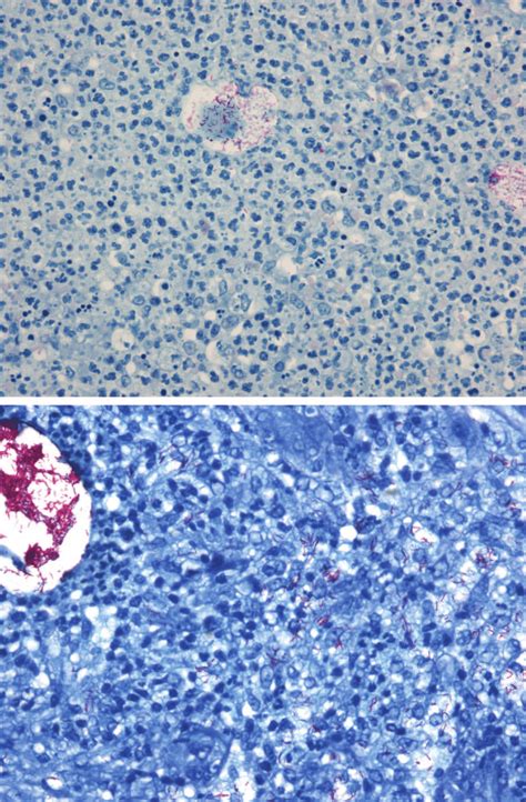 (Above) Photomicrograph showing multiple acid-fast bacilli, mostly in ...