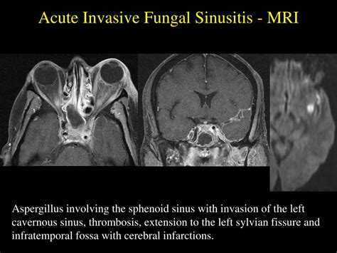 [DIAGRAM] Diagram Of Sinuses Mri - MYDIAGRAM.ONLINE