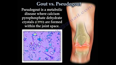 Gout Vs Pseudogout Crystals