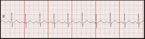 Float Nurse: Practice ECG Rhythm Strips 102