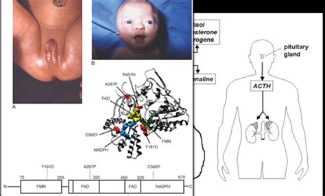 Adrenal: Congenital Adrenal Hyperplasia