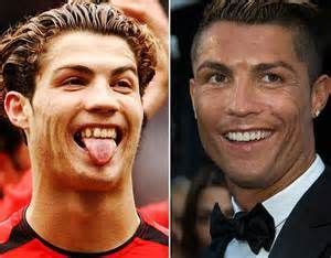 Christino-Ronaldo-plastic-Surgery and teeth | Celebrity teeth, Lake ...