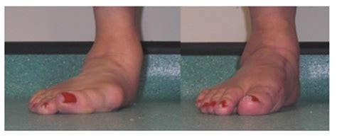 Foot Surgery for rheumatoid arthritis patients | NRAS