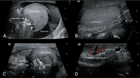 Normal Epididymis Ultrasound