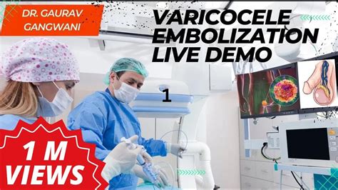 Live Varicocele Coil Embolization Procedure Varicocele Non Surgical ...