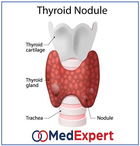 Thyroid nodules treatment, symptoms and diagnostics services | MED Expert