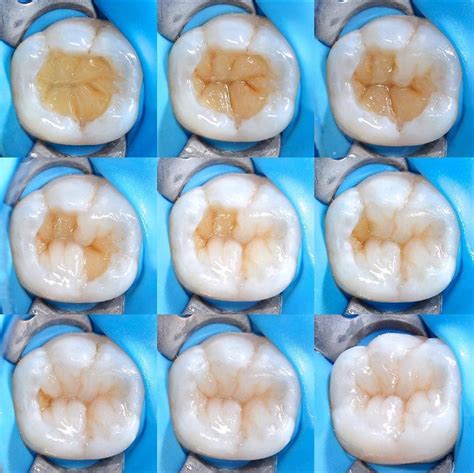 Anatomy Of A Molar Tooth