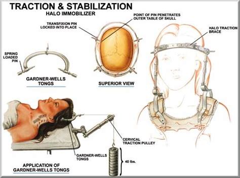 Kyle's Chiari Malformation Battle