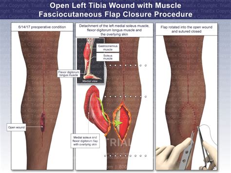 Open Left Tibia Wound with Muscle Fasciocutaneous Flap Closure Pr...