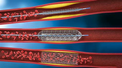 Everything You Need To Know About Getting A Stent, Cardiologist Weighs In | OnlyMyHealth