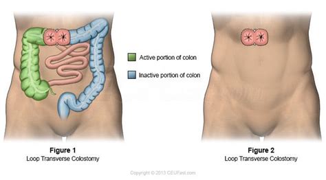 Loop or "Double Barrel" transverse colostomy Ostomy Life, Ostomy Bag, Nursing Ceu, Nursing ...