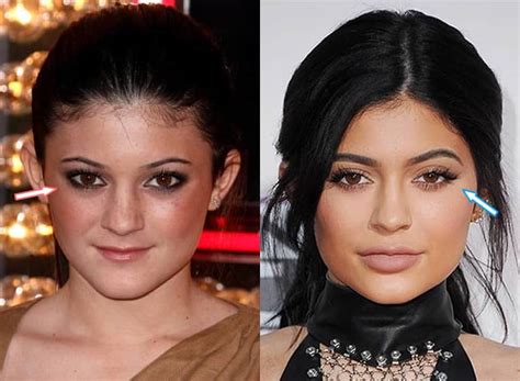 Kylie Jenner, Before and After Transformation