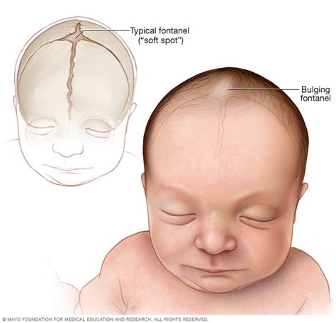 Encephalitis - Symptoms and causes - Mayo Clinic