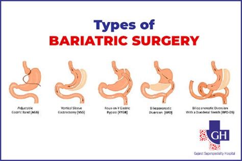 Types of Bariatric Surgery | types of weight loss surgery | GSH